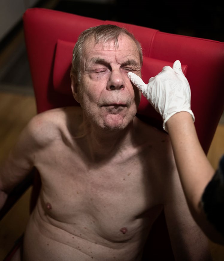 – En ældre mand får hver aften dryppet øjne pga. grøn stær. Hans hverdag er plaget af mange indre dæmoner, fortæller socialpædagog Susan Buchard. – Vores fornemste opgave er at oversætte og dosere den enkelte borgers behov til handling. Og for denne borger gør dette faste aftenritual ham tryg, rolig og afslappet.